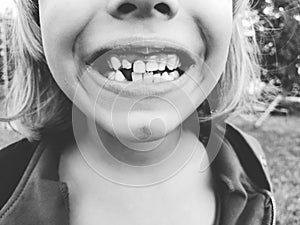 Loss of milk teeth. A 6-year-old girl smiles and shows her teeth. Several teeth are missing. Black and white monochrome