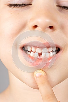 Loss of milk teeth in children. A six-year-old child shows the first baby tooth that has fallen out