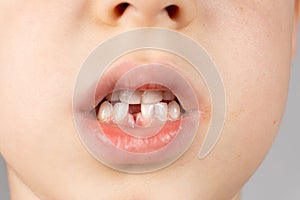 Loss of milk teeth in children. A six-year-old child shows the first baby tooth that has fallen out