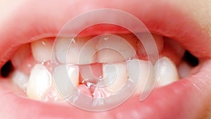 Loss of milk teeth in children. A six-year-old child shows the first baby tooth that has fallen out