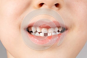 Loss of milk teeth in children. A six-year-old child shows the first baby tooth that has fallen out