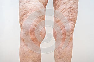 A lot of excess loose skin on legs of a senior woman after weight loss, gastric bypass surgery