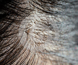 Louse egg on the hair causes itchy head