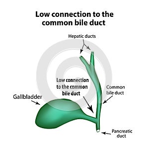 Low connection to the common bile duct. Pathology of the gallbladder. Cholecystitis. photo