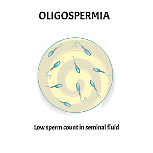 Low sperm count in seminal fluid. Low abundance of sperm in the ejaculate. Male infertility Oligospermia. Spermogram