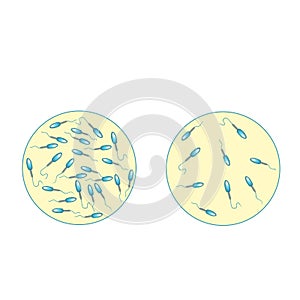 Low sperm count in seminal fluid. Low abundance of sperm in the ejaculate. Male infertility Oligospermia. Spermogram