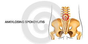 Lower back, suffering from ankylosing spondylitis