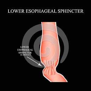 Lower cardiac esophageal sphincter. Infographics. Vector illustration on black background. photo