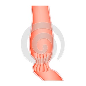 Lower cardiac esophageal sphincter. Infographics. Vector illustration on isolated background.