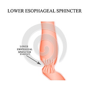 Lower cardiac esophageal sphincter. Infographics. Vector illustration on isolated background. photo