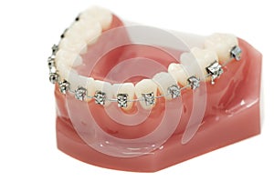 Lower dental jaw bracket braces