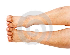 Lower extremity disease photo