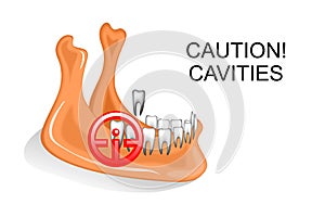 The lower jaw, the teeth, dental caries