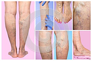 Lower limb vascular examination because suspect of venous insufficiency.