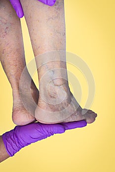 Lower limb vascular examination because suspect of venous insufficiency.