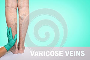 Lower limb vascular examination because suspect of venous insufficiency