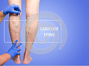 Lower limb vascular examination because suspect of venous insufficiency.