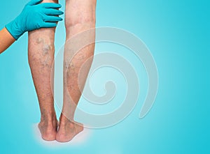 Lower limb vascular examination because suspect of venous insufficiency