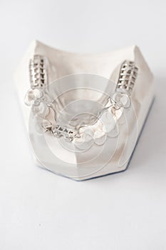 Lower partial denture with attachments