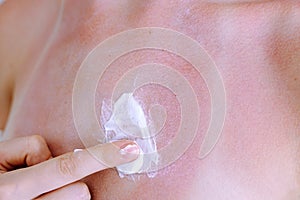 Lubricate skin after sunburn with cream