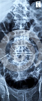 Lumbar disc herniation photo