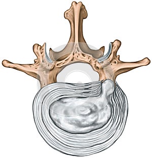 Lumbar disk herniation