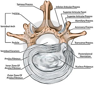 BOARD Lumbar disk herniation photo