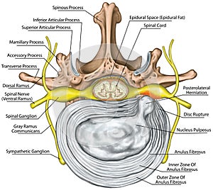 BOARD Lumbar disk herniation, nerve root photo