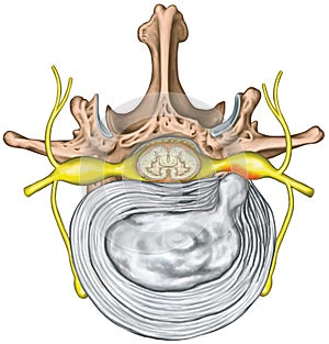 Lumbar disk herniation, nerve root photo