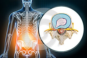 Lumbar hernia and vertebra with herniated disc medical diagram 3D rendering illustration. Backache, spine pathology, injury,