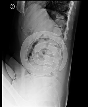 Lumbosacral spine x-ray. Lateral view.