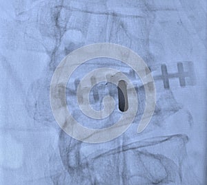 Lumbar pain treatment radiofrequency ablation