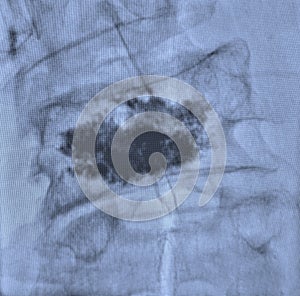 Lumbar pain treatment radiofrequency ablation