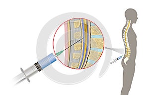 Lumbar puncture also known as a spinal tap, is a medical procedure in which a needle is inserted into the spinal canal. Cerebrospi