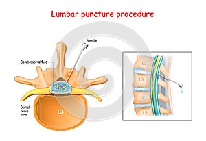 Lumbar puncture procedure