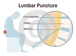 Lumbar puncture. Spinal tap, needle insertion into the space between