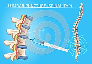 Lumbar Puncture Realistic Vector Medical Scheme