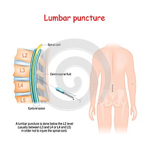 Lumbar Puncture. Spinal Tap Procedure. Syringe needle inserted into Epidural space