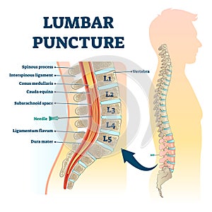 Lumbar puncture vector illustration. Labeled spine structure procedure scheme photo