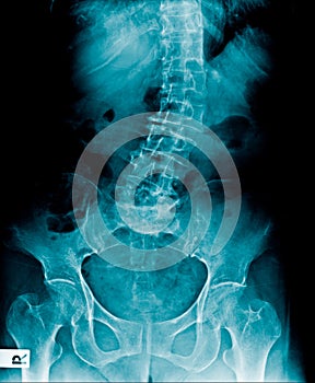Scoliosis lumbar x-ray image photo