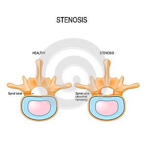 Lumbar Spinal Stenosis