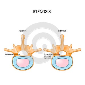 Lumbar Spinal Stenosis photo