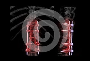 lumbar spine AP and Lateral view  for diagnosis spinal canal stenosis and degenerative disc disease showing pedicle screw implant