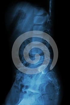 Lumbar spine of child ( X-ray thoracic - lumbar spine )