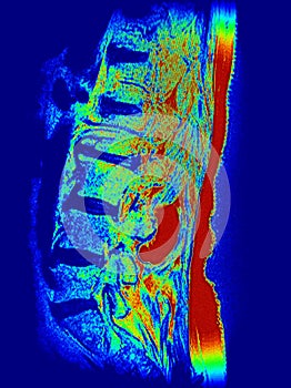 Lumbar spine cystic lesion synovial cyst mri