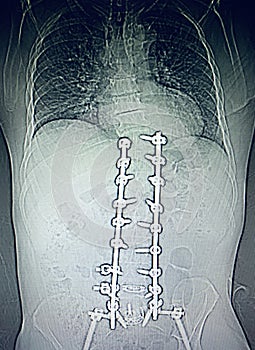 Lumbar spine fusion hardwear  stabilization device