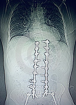 Lumbar spine fusion hardwear  stabilization device photo