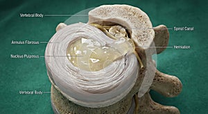 Lumbar spine intervertebral herniated disc sciatica visualization, detailed 3D top view cross section showing annulus fibrosus