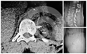 Lumbar spine moderate disc extrusion ct collage