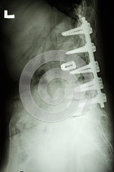 Lumbar spine with pedicle fixation